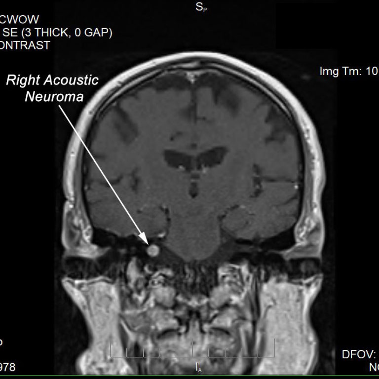 Acoustic Neuroma Atlantic ENT LLCAtlantic ENT LLC