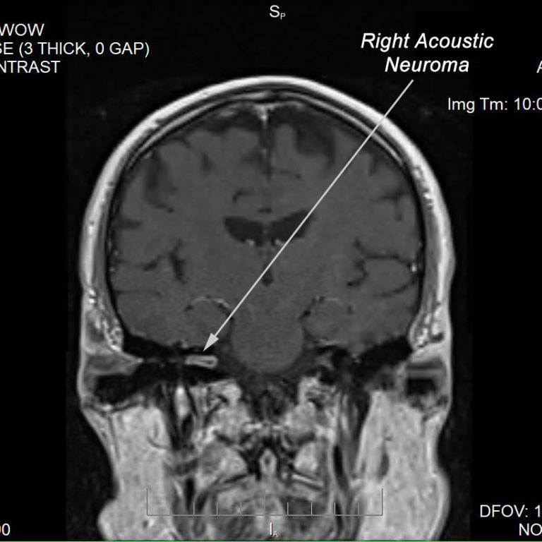 Acoustic Neuroma Atlantic ENT LLCAtlantic ENT LLC